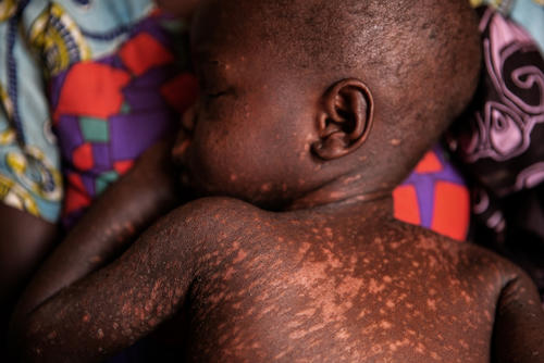 MSF Measles Intervention Bezambe: Nina and Ornella