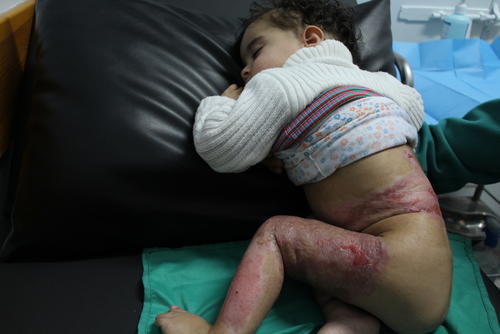 Testimonies of burn and trauma patients in Gaza Testimonies of burn and trauma patients in Gaza