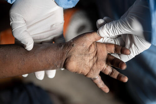 Mpox Cases Amidst Displacement Sites Near Goma