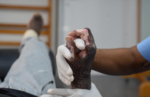 The long road to recovery for burn patients The long road to recovery for burn patients