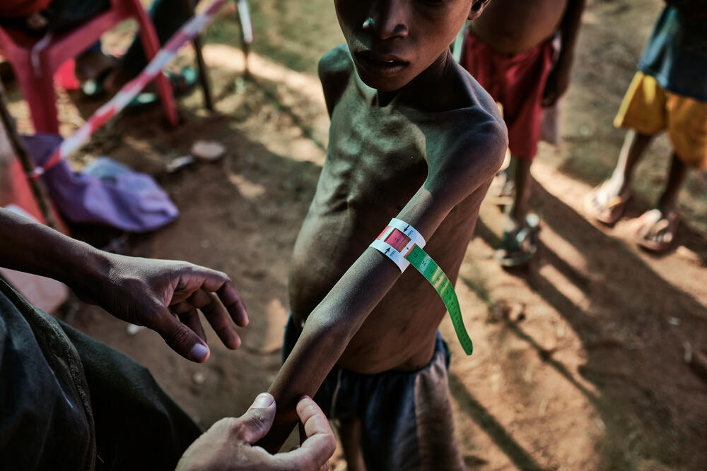 The MUAC (Mid-Upper Arm Circumference) measurement is a quick way of identifying children at risk of malnutrition. This child is suffering from severe acute malnutrition and will be integrated into the programme.