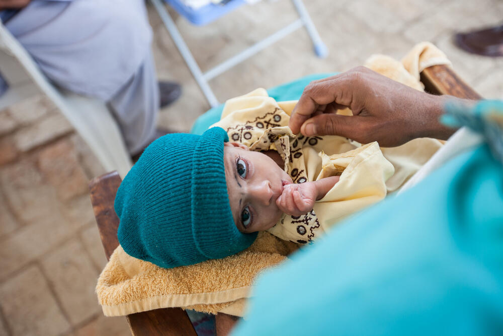 A malnourished one-year-old in the ambulatory therapeutic feeding centre set up by MSF in Cattle Farm, Balochistan.