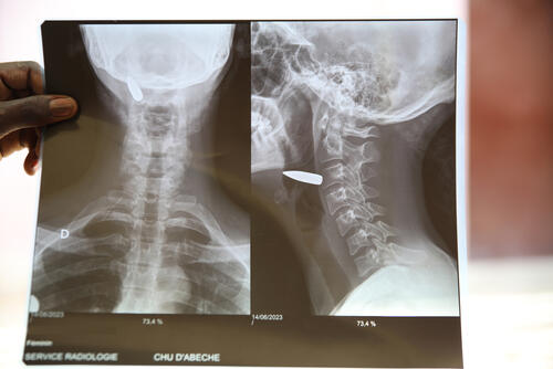 An X-ray of a Sudanese refugee with a gunshot wound to the neck – treated by MSF staff in Chad