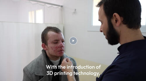How 3D technologies help burn patients in Syria