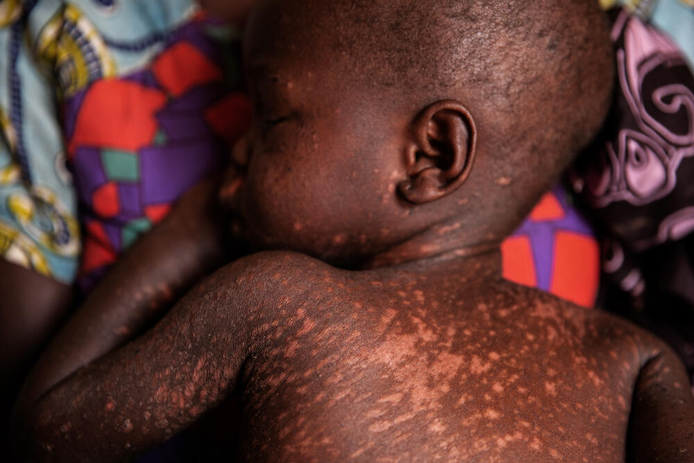 Measles In The Shadow Of COVID 19 MSF UK