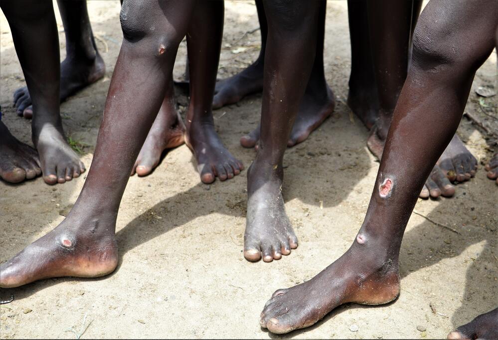 Children waiting at MSF’s mobile clinic in Lanyeris show their wounds from walking through floodwaters