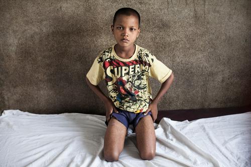 A young kala azar patient in India