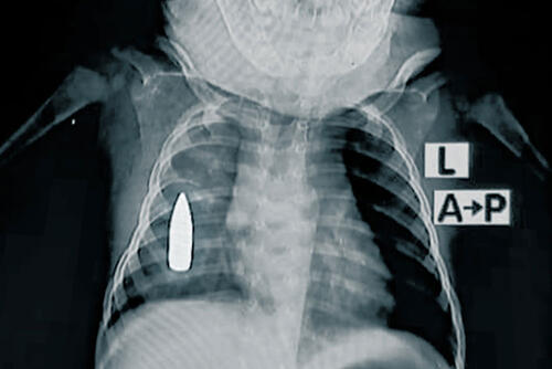 An X-ray of an 18-month-old with a gunshot injury, taken at an MSF-supported hospital in Khartoum