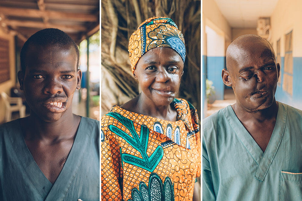 Noma survivors Muhammadu, Mulikat and Dahiru all work at the MSF-supported Sokoto Noma Hospital