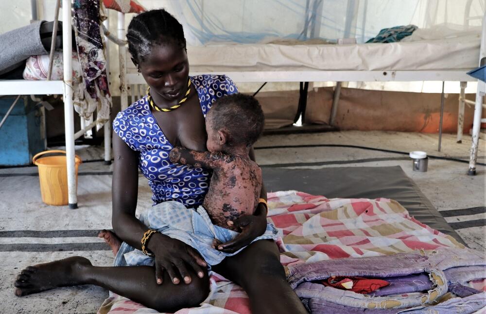 Wovo Logocho breastfeeds her baby with severe measles in MSF’s clinic in Pibor town.