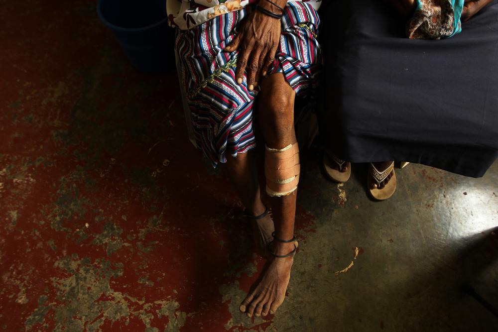 A patient displays her bandaged leg in the MSF Family Support Centre where she is being treated in Tari. She was attacked while attending her daughter's funeral.