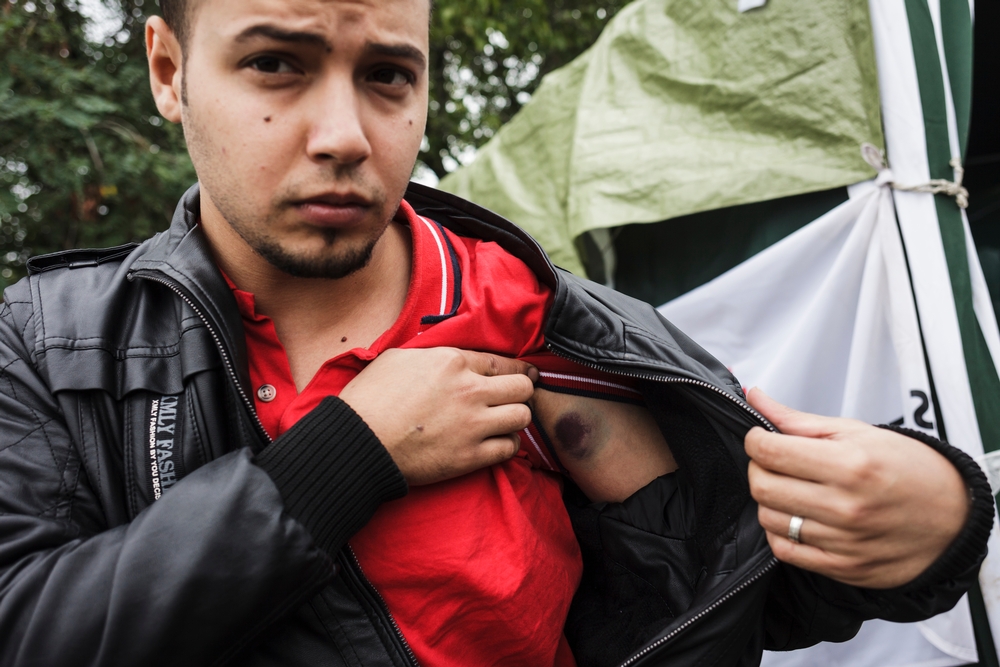 Mustafa (27), uprchlík z iráckého Baghdádu, ukazuje modřinu, kterou utržil, když byl po cestě napaden.
